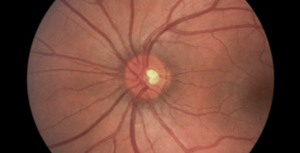 retinal-image